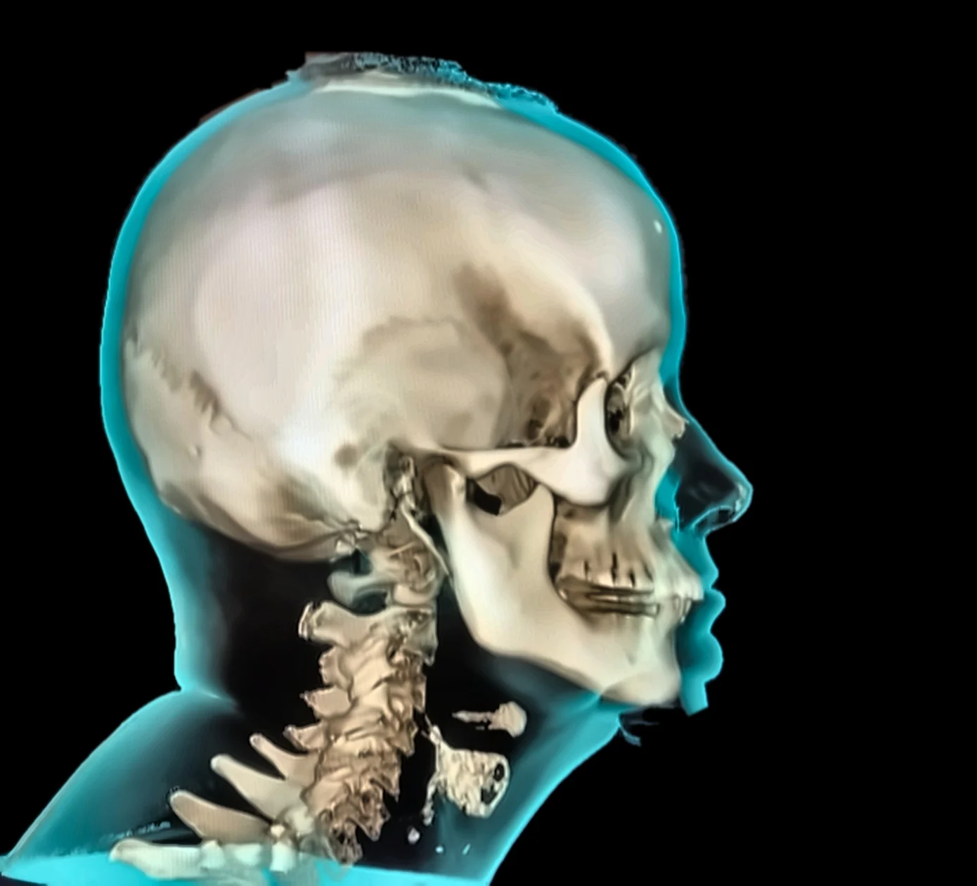 Side-profile 3D render of the skull and cervical spine inside a translucent head outline